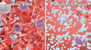 plasma-arricchito-di-piastrine-platelet-rich-plasma